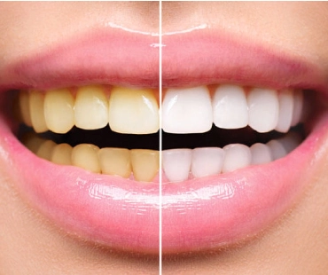 Estética dentária