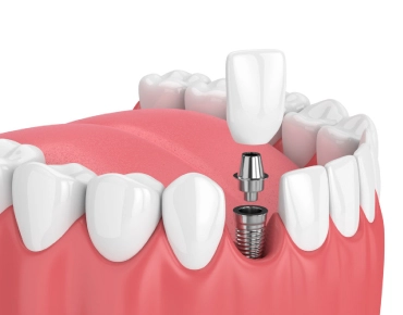 Implantes dentários: tudo o que sempre quis saber.